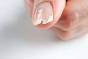 Brittle splitting nails