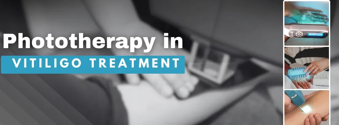 Phototherapy in Vitiligo Treatment