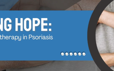 Beaming Hope: Exploring Phototherapy in Psoriasis Treatment