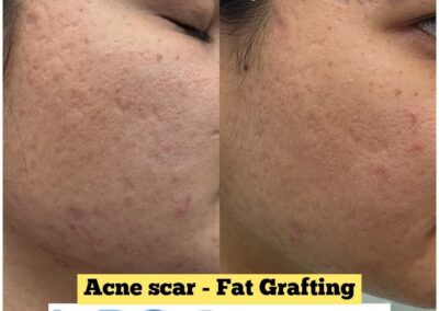 Acne Scar - Fat Grafting