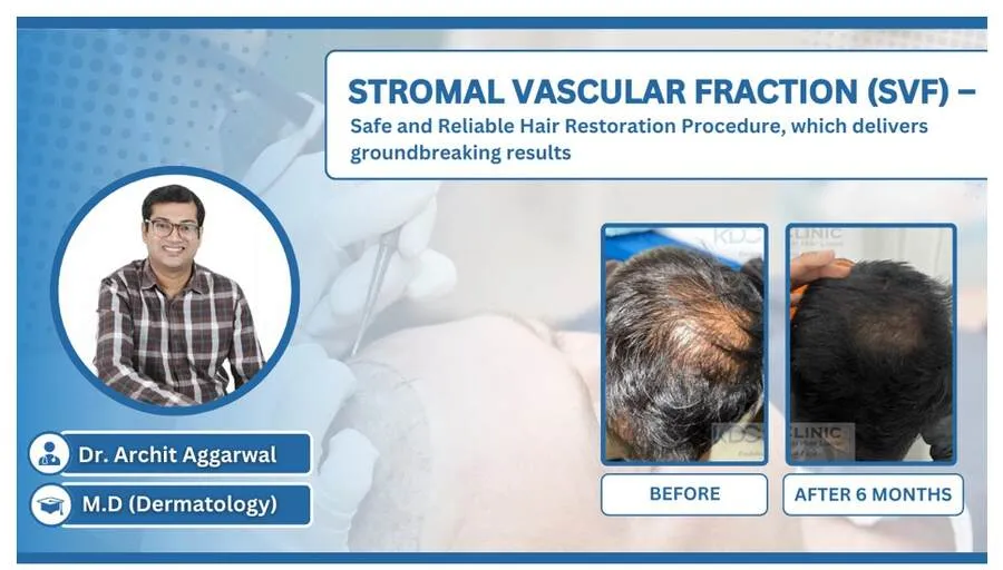 Stromal Vascular Fraction (SVF) – Safe and Reliable Hair Restoration Procedure, which delivers groundbreaking results