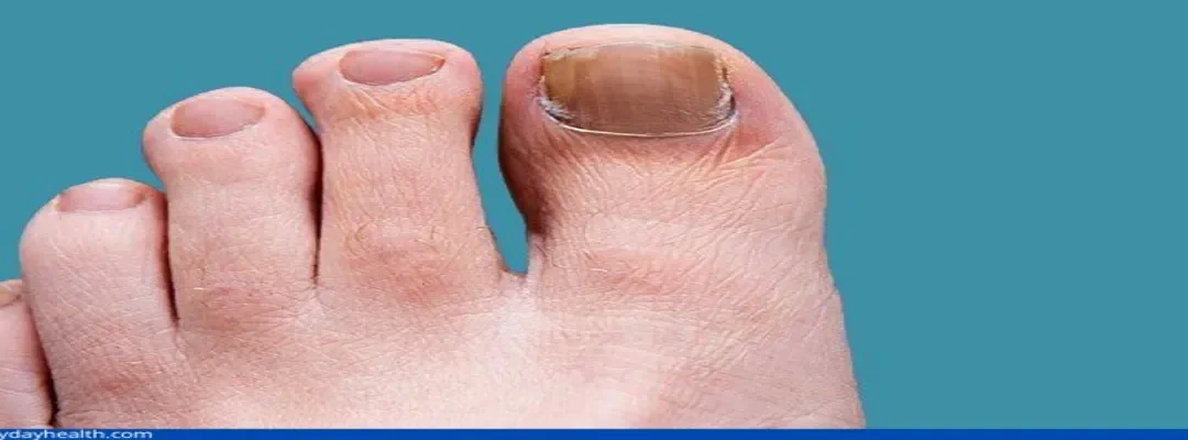 Debunking Common Myths About Toenail Fungus