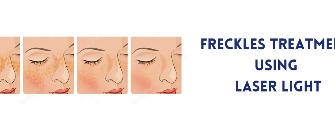 Freckles treatment using Laser Light