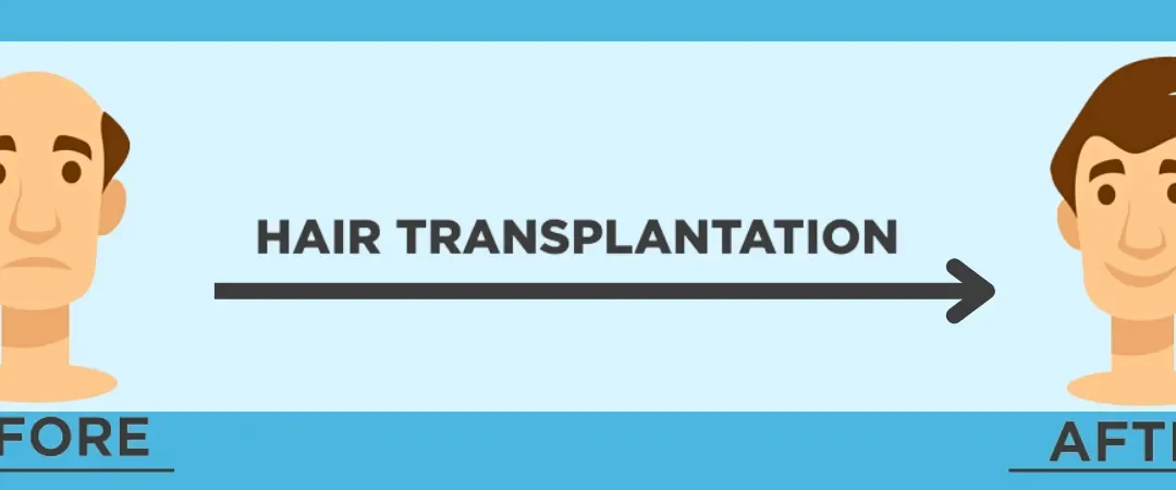How Effective Are Various Hair Transplant Techniques