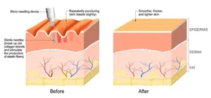 Overview of Microneedling Radiofrequency