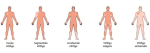Types of vitiligo