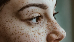 causes freckles
