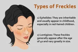 different types of freckles