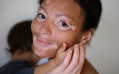 Trichrome Vitiligo