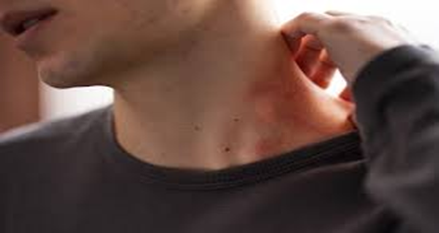 rosacea-on-neck-and-chest