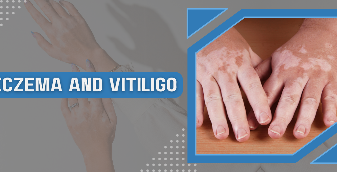 Eczema And Vitiligo