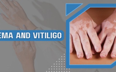 Eczema and Vitiligo – Insights, causes, and solutions