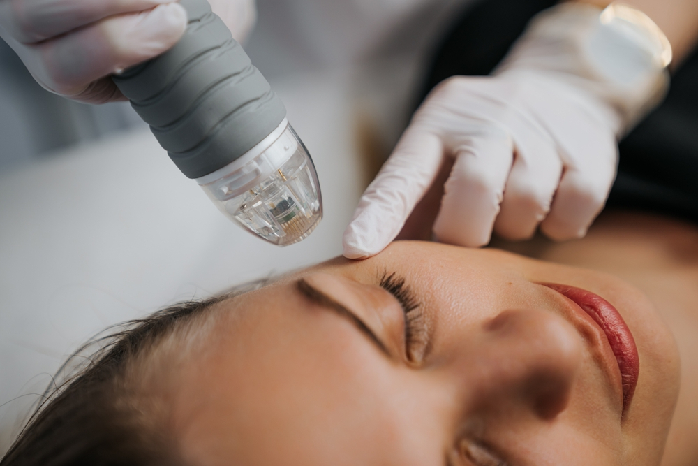 Microneedling Radiofrequency Treatment Process