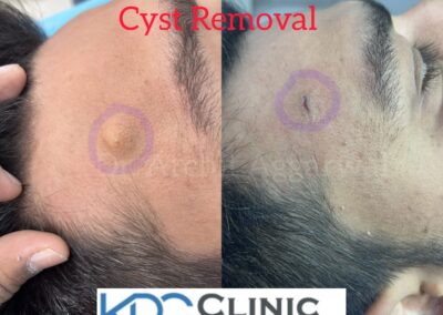Cyst Removal