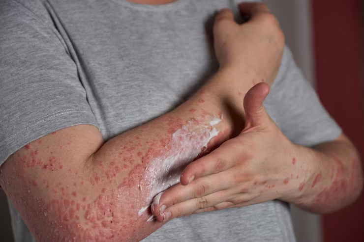 Eczema and Vitiligo