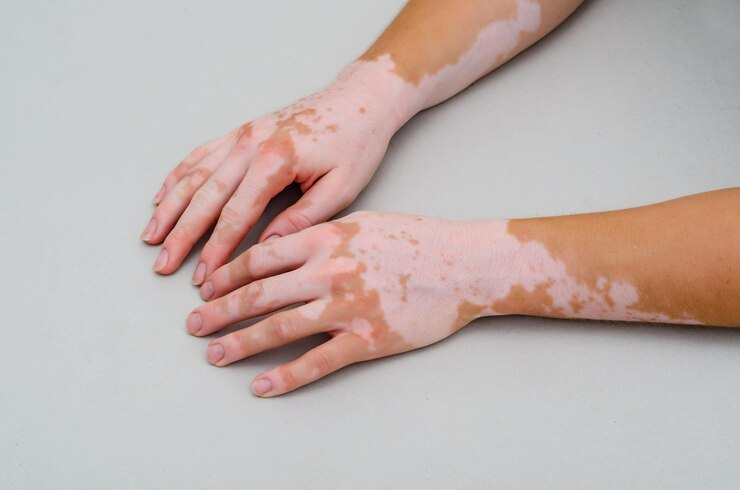 Understanding Eczema and Vitiligo